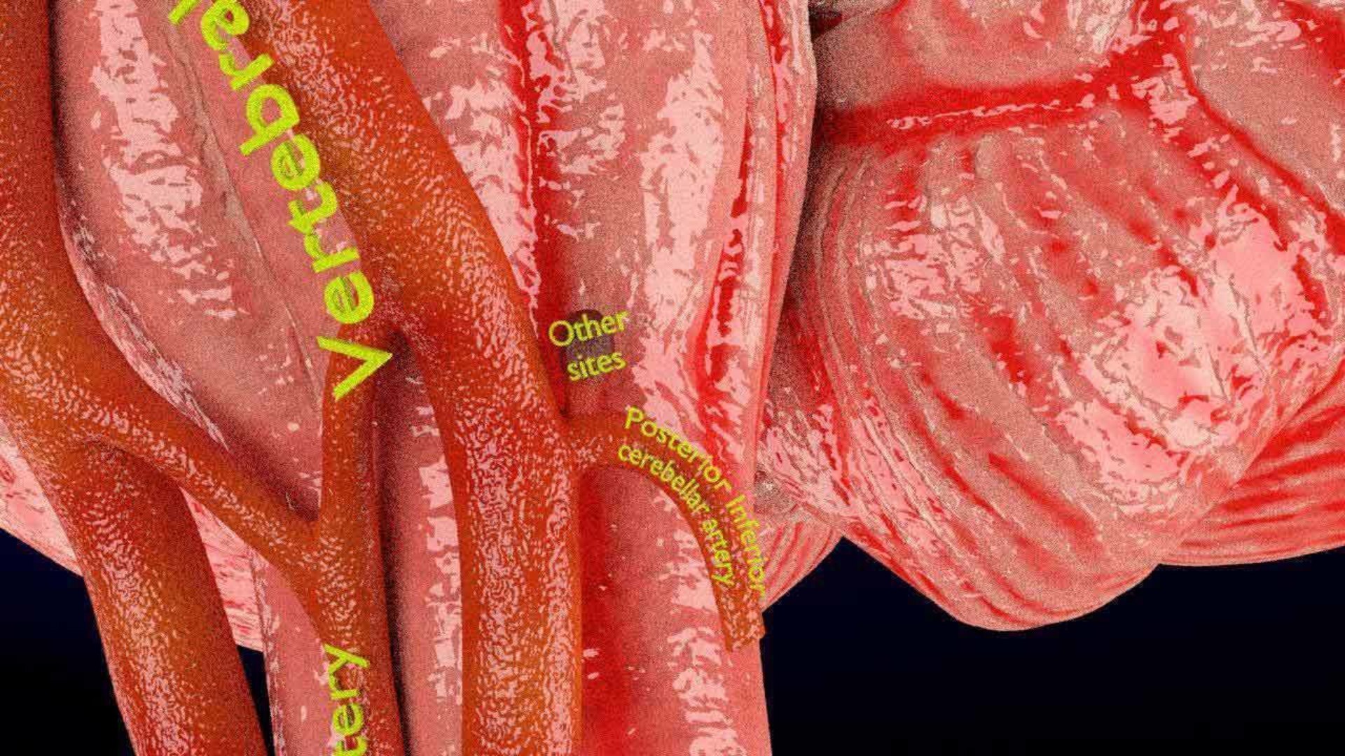Cerebral aneurysms berry circle of willis 3D model https://p.turbosquid.com/ts-thumb/S0/8AcZxw/m2/2/jpg/1679588172/1920x1080/fit_q87/a791d396fb07e32324a6286f471b1331ad181e87/2.jpg