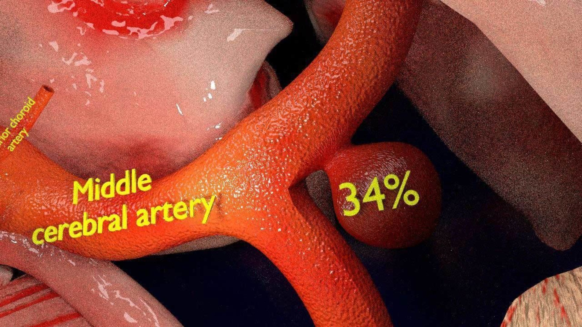 Cerebral aneurysms berry circle of willis 3D model https://p.turbosquid.com/ts-thumb/S0/8AcZxw/me/7/jpg/1679588175/1920x1080/fit_q87/eef50ebdb98e83eacdf1603f550106168201f980/7.jpg