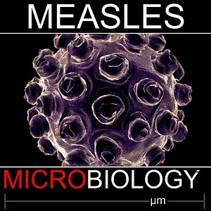 measles