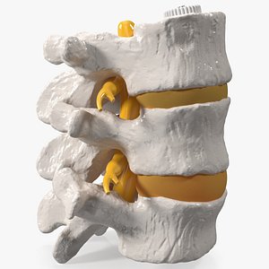 Spinal Vertebrae with Hernia