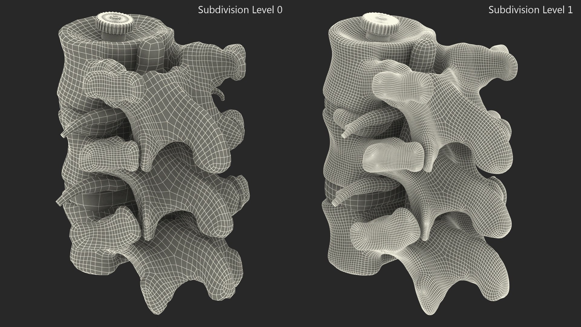 Spinal Vertebrae with Hernia 3D model - TurboSquid 2046447