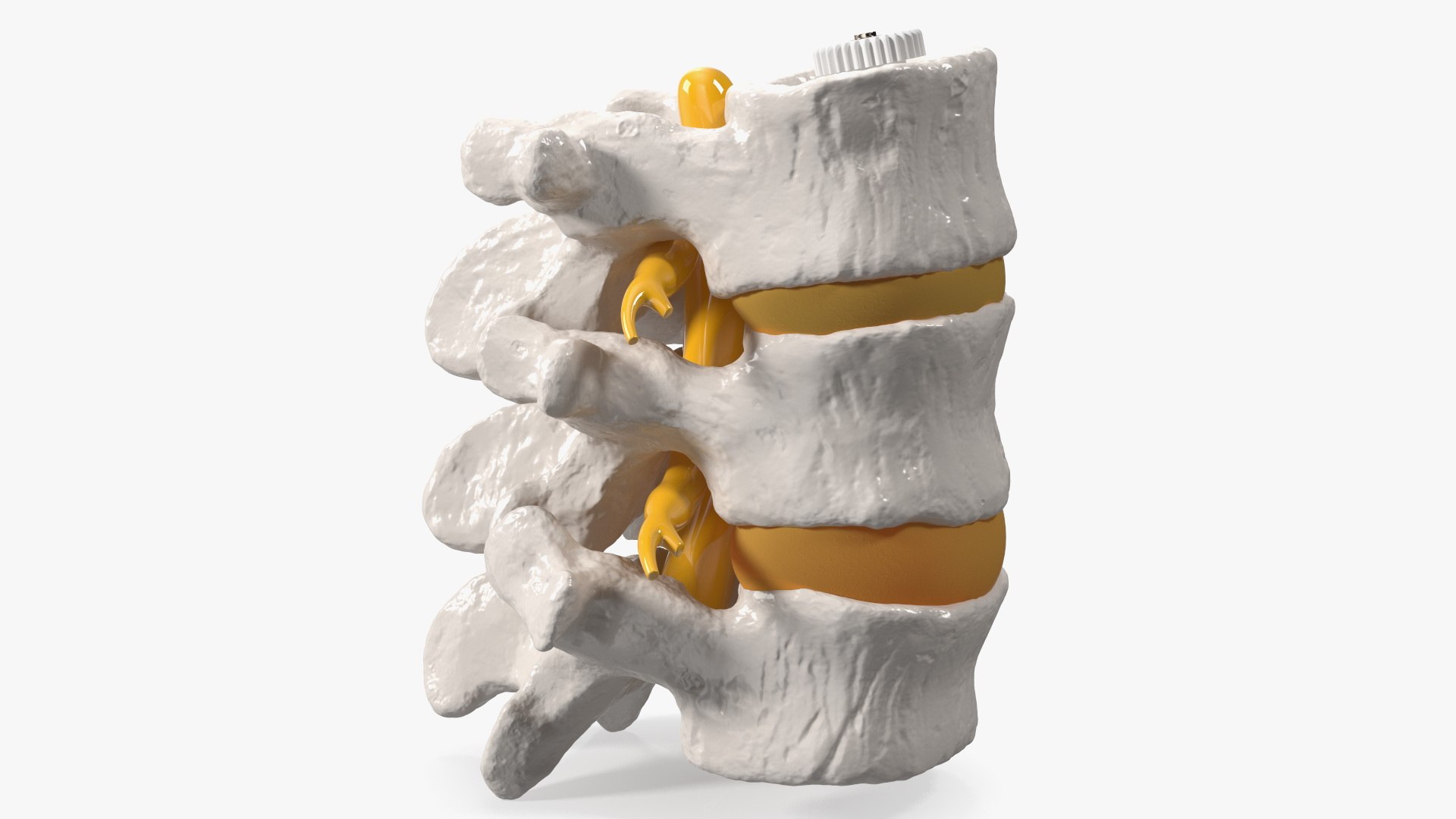Spinal Vertebrae with Hernia 3D model preview