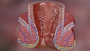 Hemorrhoid