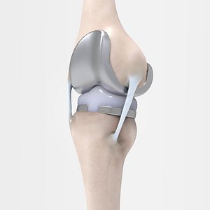 3D knee replacement