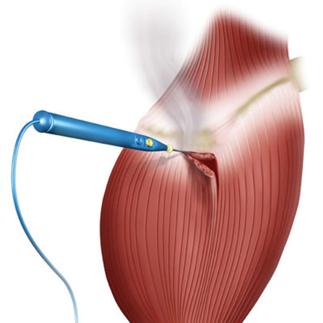 3d Model Electric Scalpel