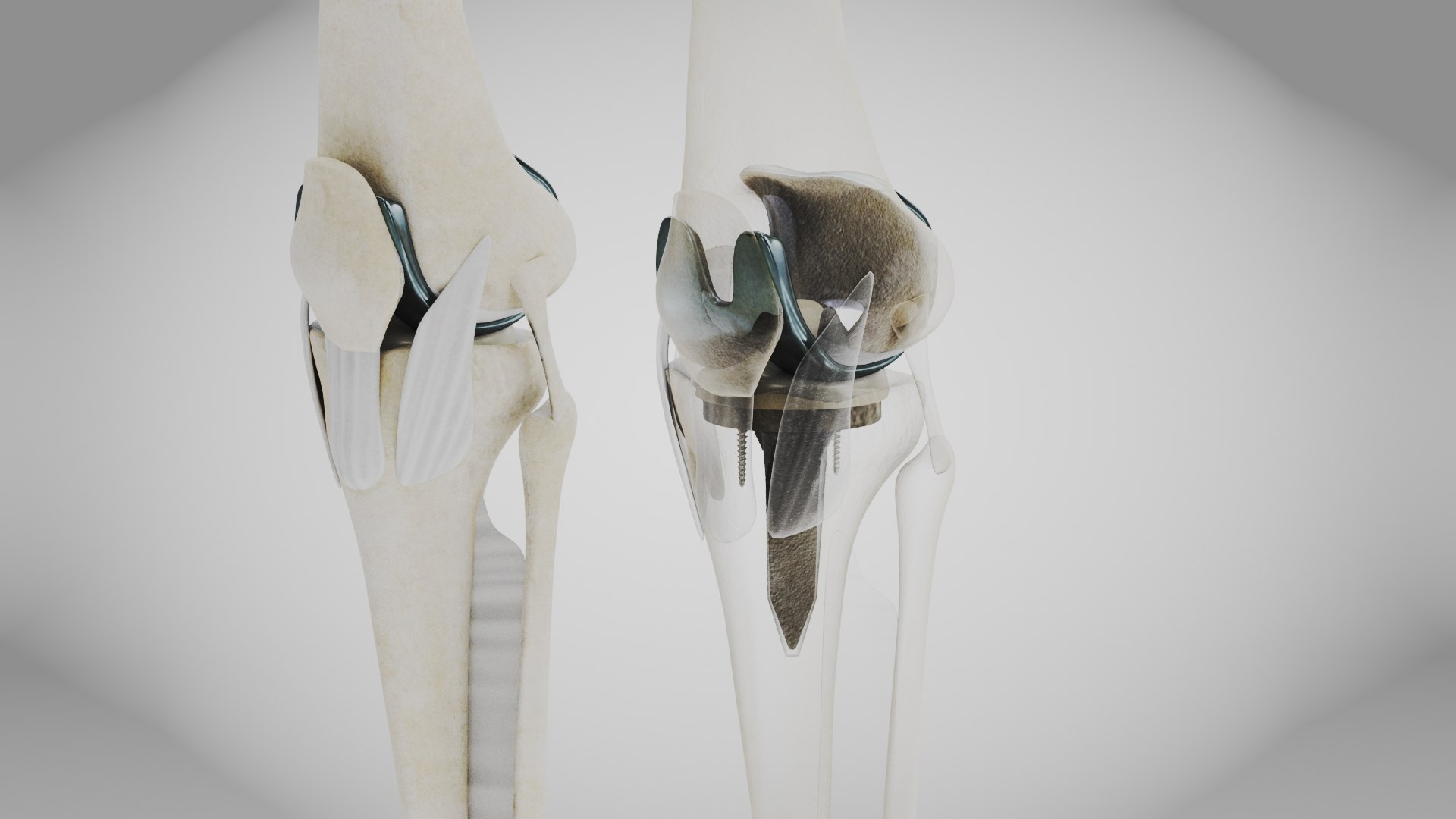 Replaced Knee Implant Model - TurboSquid 2133197