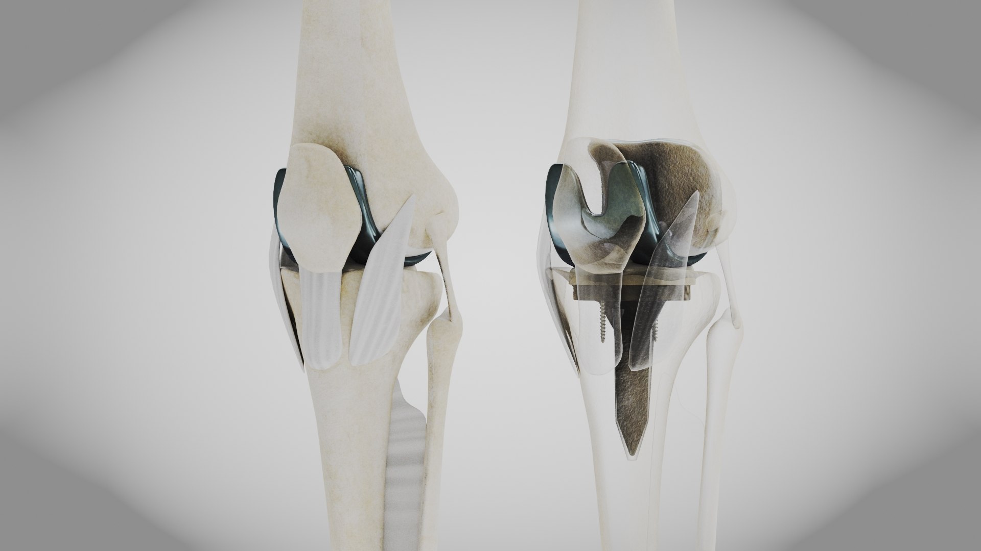 Replaced Knee Implant Model - TurboSquid 2133197