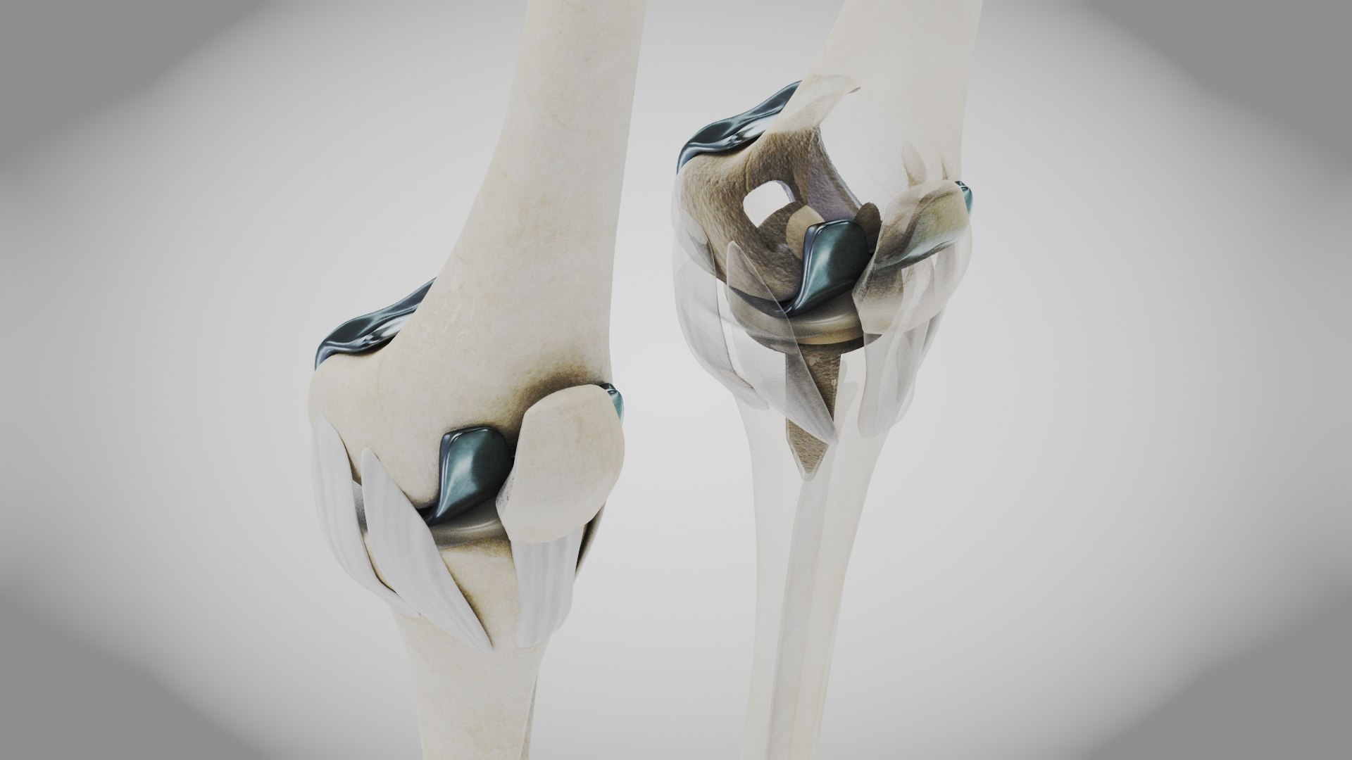 Replaced Knee Implant Model - TurboSquid 2133197