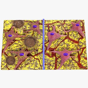 Alzheimer disease microscopy changes brain model