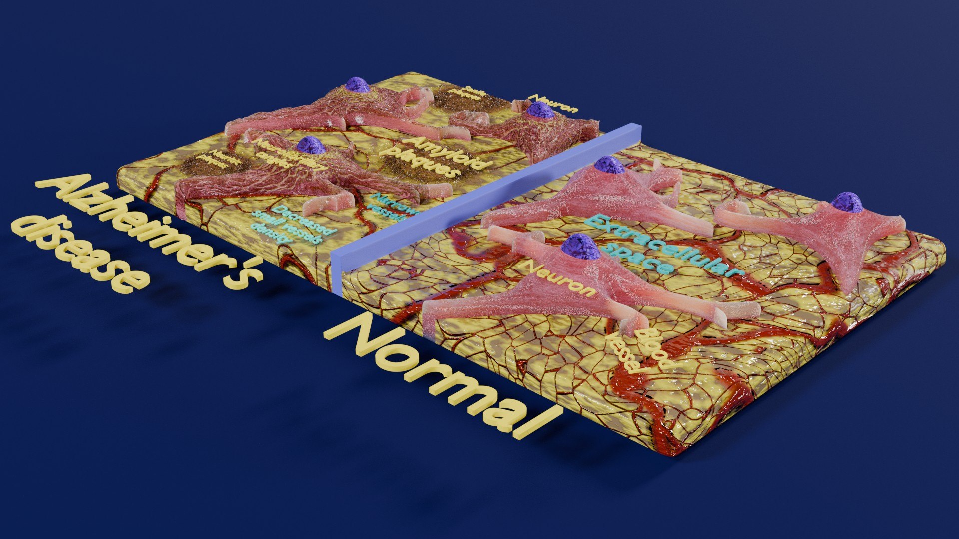 Alzheimer disease microscopy changes brain model https://p.turbosquid.com/ts-thumb/T2/40wcln/Nn/aa0001/jpg/1742548264/1920x1080/fit_q87/d1e71837b98ef6d45817b8018c0b37d4d2209ac0/aa0001.jpg