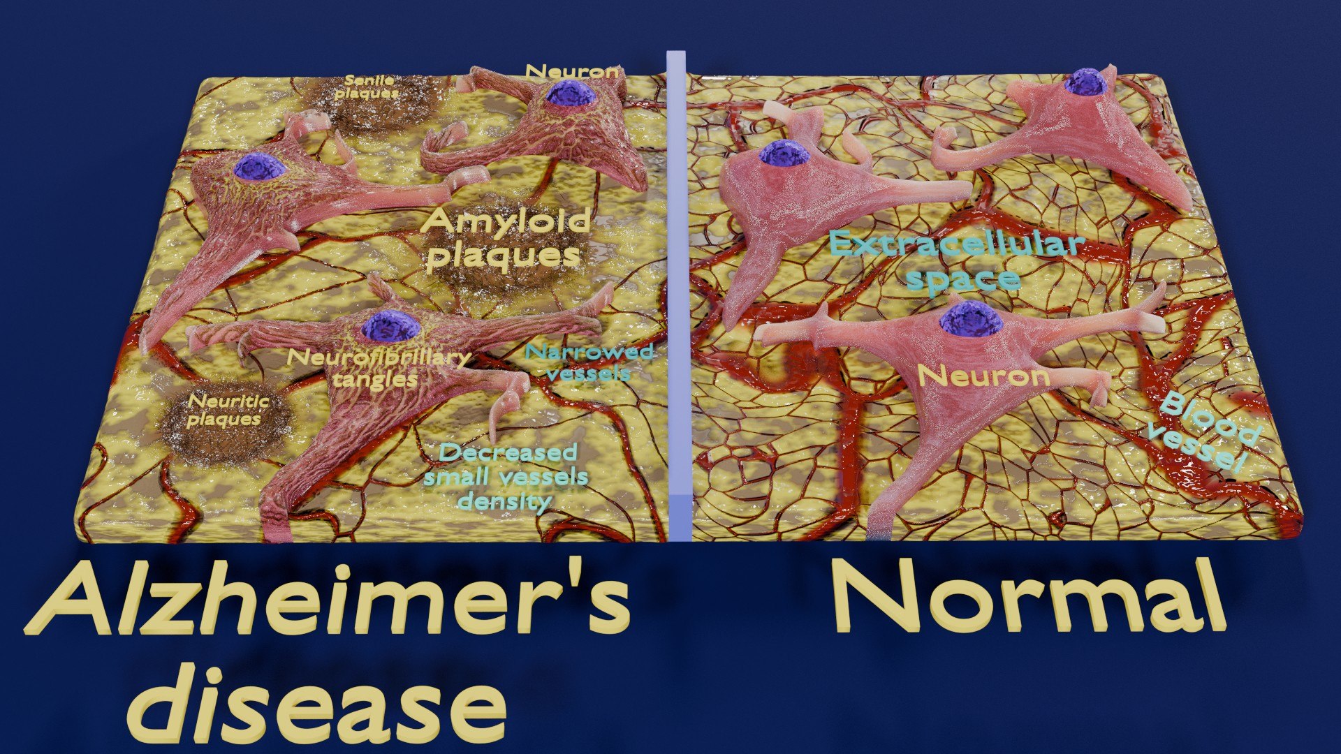 Alzheimer Disease Microscopy Changes Brain Model - TurboSquid 2379501