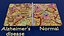 Alzheimer disease microscopy changes brain model