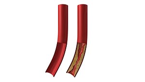 3d artery disease coronary model