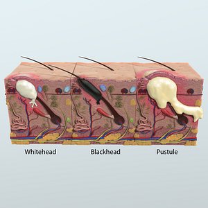 realistic skin acne anatomy 3D model