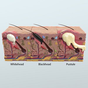 Realistic 3D Skin Acne Anatomy