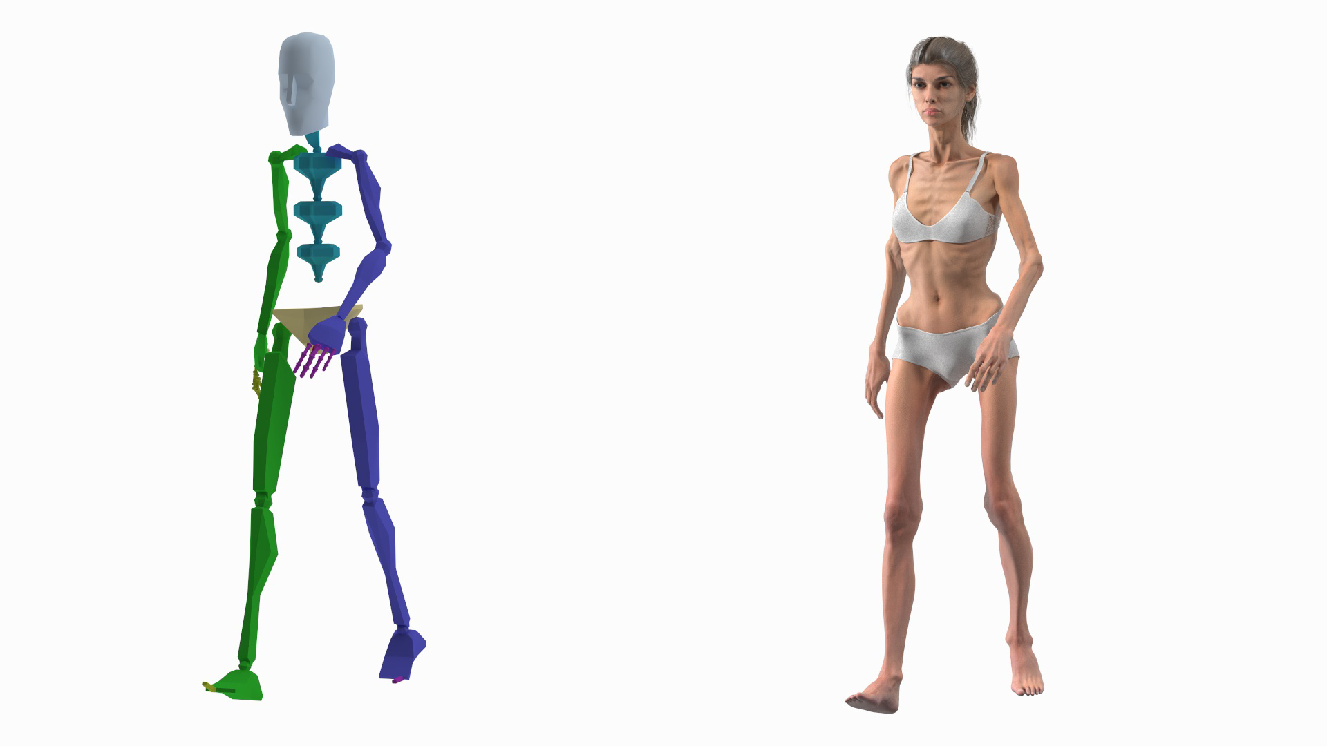 anorexic 