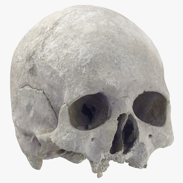 human skull cranium leprosy 3D model