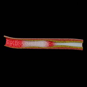 3D Hypertension blood vessel artery structural change model