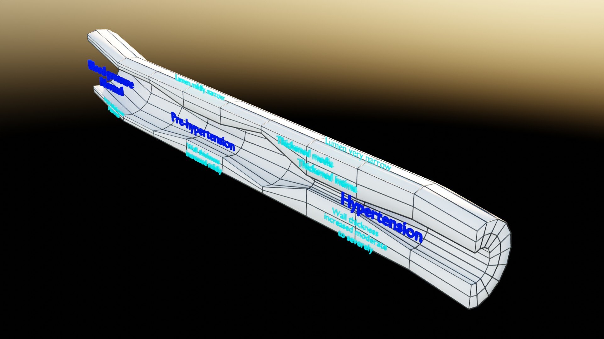 3D Hypertension Blood Vessel Artery Structural Change Model ...