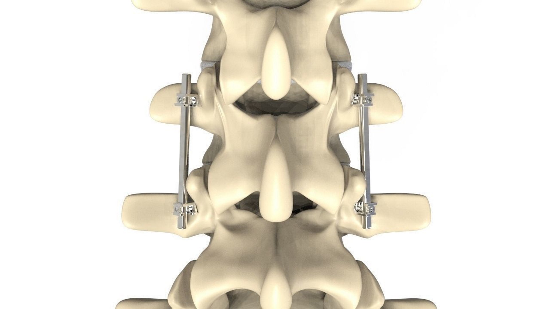 Spine Human Implant 3D Model - TurboSquid 1559427