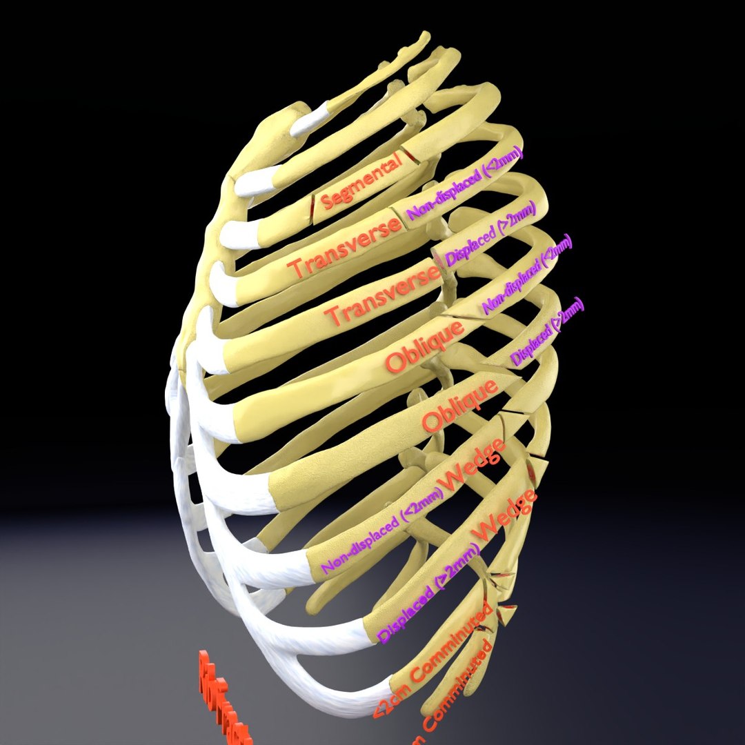 Rib Fracture And Its Types Model - TurboSquid 2278226