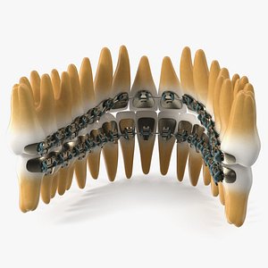 Lingual Braces on Teeth 3D model