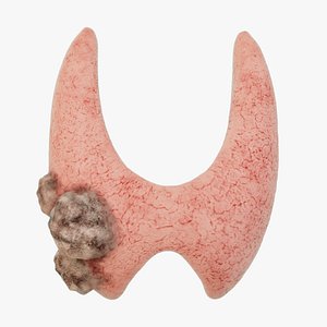 3D Thyroid cancer  the lump appears animated Human organ