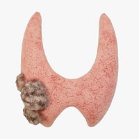 Thyroid cancer  the lump appears animated Human organ