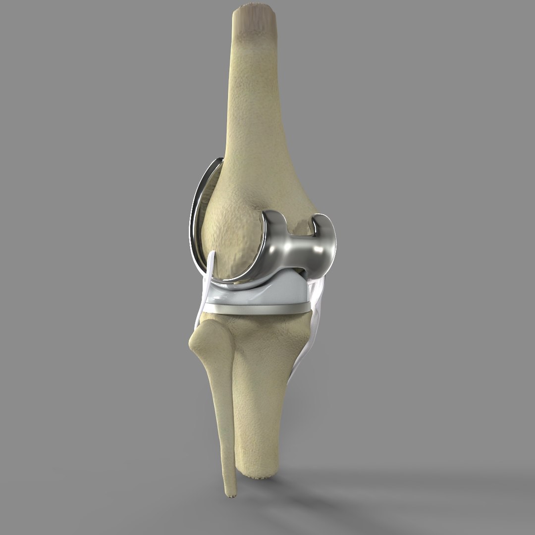 3D Knee Replacement Model - TurboSquid 1520233