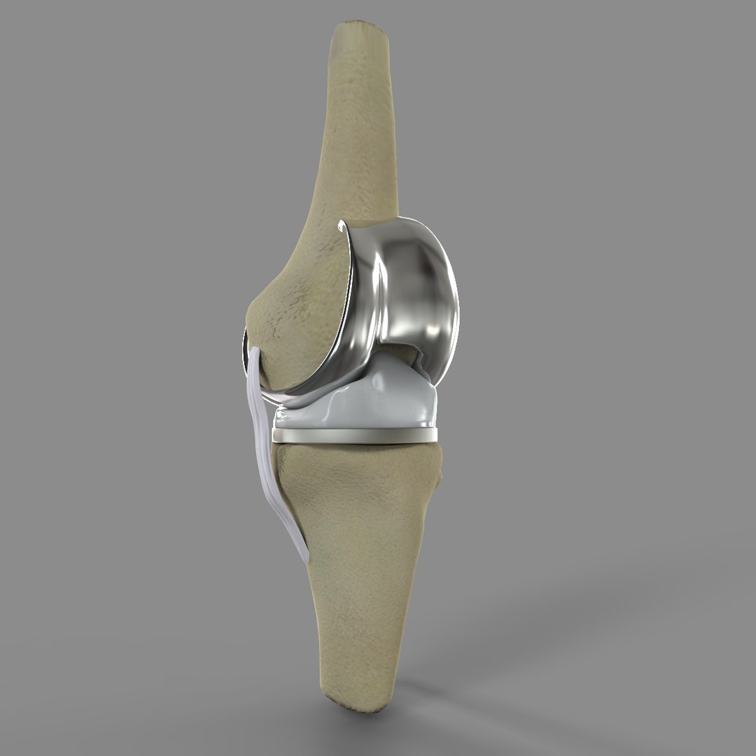 3D Knee Replacement Model - TurboSquid 1520233