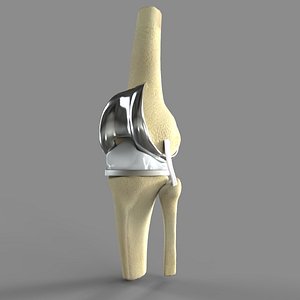 3D knee replacement model