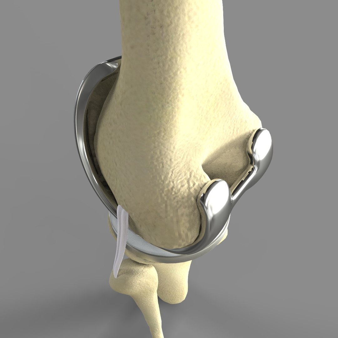 3D knee replacement model https://p.turbosquid.com/ts-thumb/UZ/ReHUao/iwT1gKog/untitled.17/jpg/1583703941/1920x1080/fit_q87/6a662a6ea7dfe7468517bc4006340d5af29cc57d/untitled.17.jpg