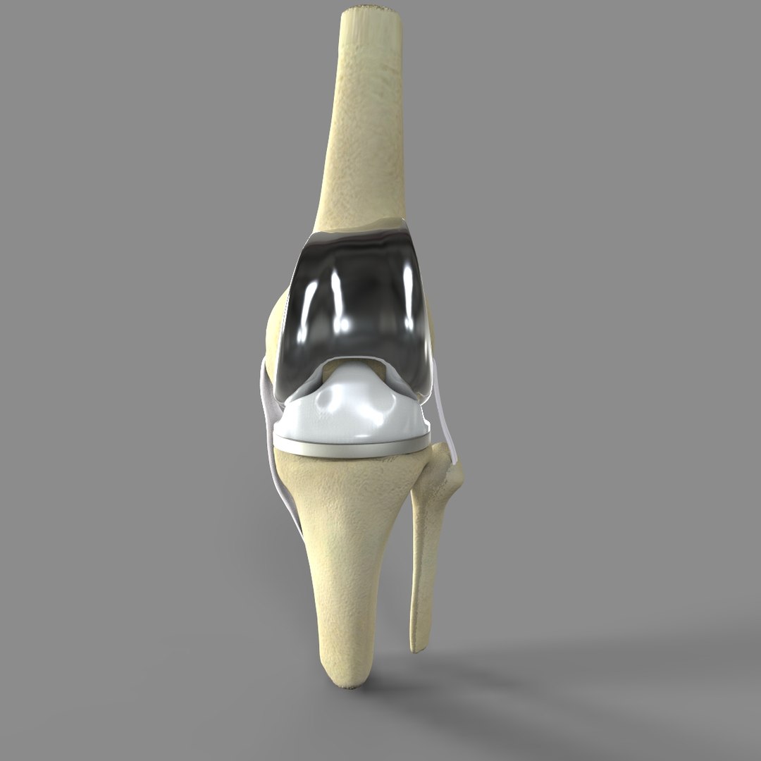 3D Knee Replacement Model - TurboSquid 1520233