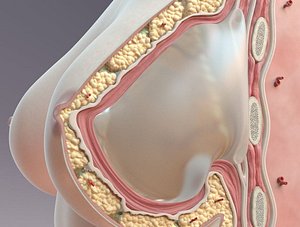 Breast Cross Section Implant