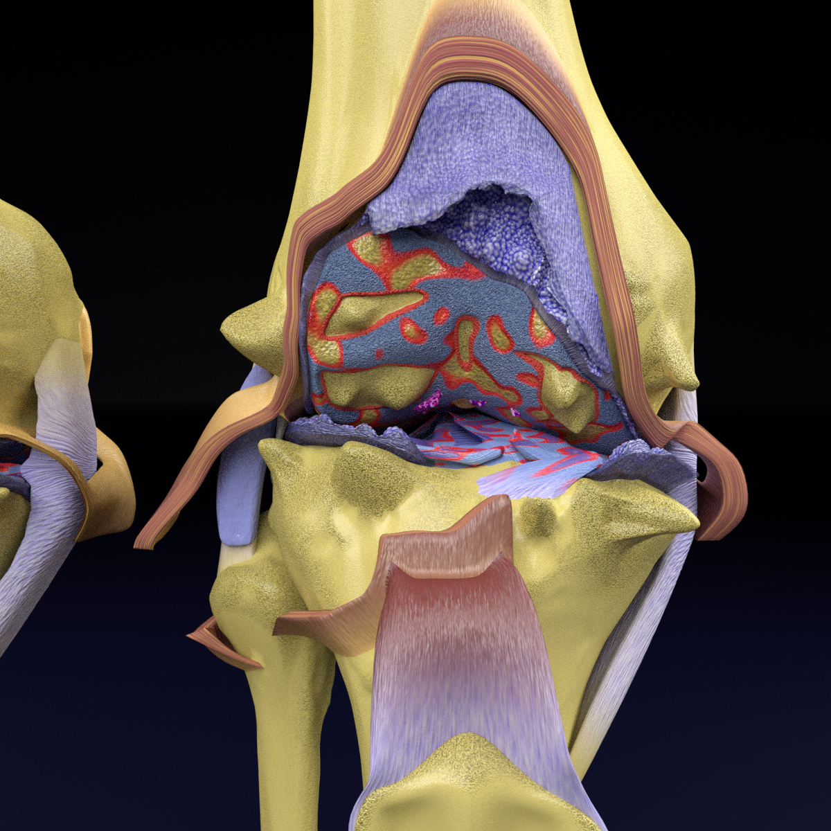 Osteoarthritis Stages 3d Turbosquid 1663612