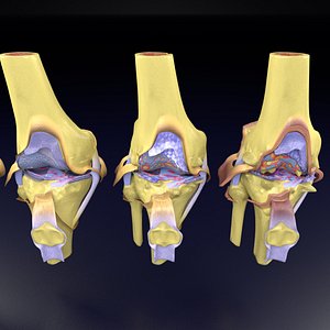 Osteoarthritis stages