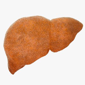 Hepatitis  liver disease digestive system organs