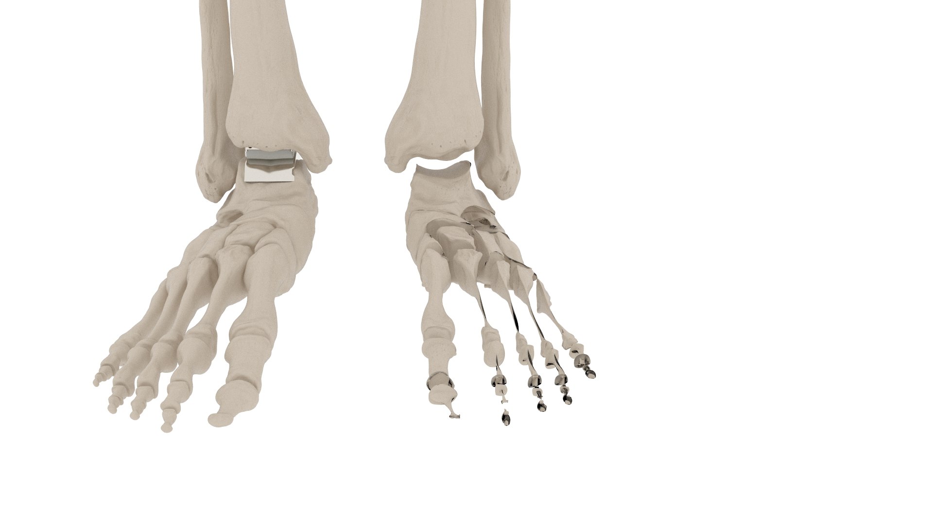 3D Male Skeleton with Joint Implants Ivory https://p.turbosquid.com/ts-thumb/Vc/ZWFCTh/Kw/980/jpg/1776850362/1920x1080/fit_q87/ffdbd23bdf47087e41fc5d057b43fb80646146be/980.jpg