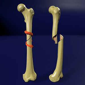 Spiral Fracture skeleton labelled femur
