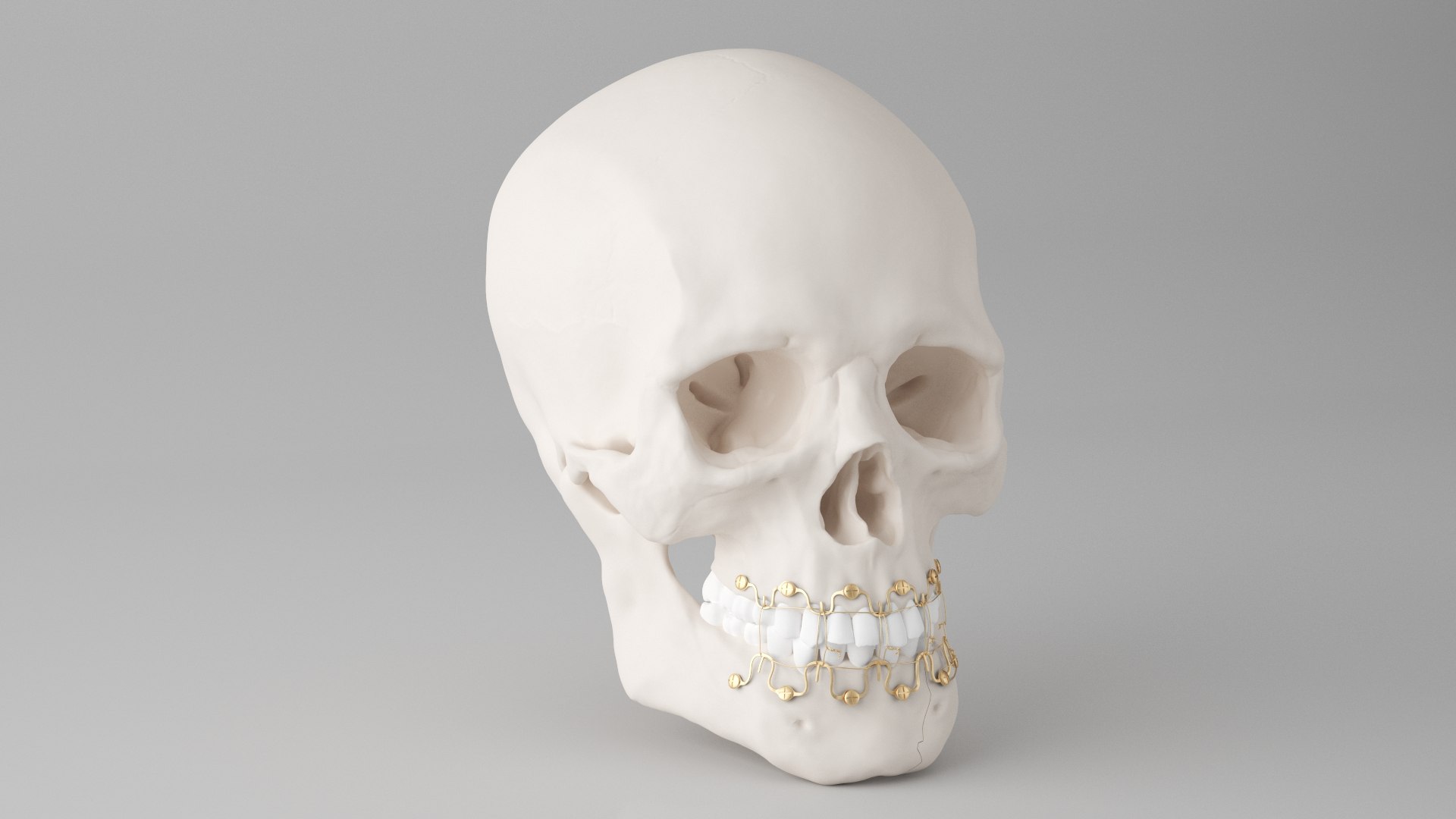 Male Skull - Mandible fracture 3D model https://p.turbosquid.com/ts-thumb/W6/IoJ3xH/4W/mandiblefracturepack01/jpg/1726988320/1920x1080/fit_q87/1a9fd00a34ccdc715bf28b42c9fb115e36d343e8/mandiblefracturepack01.jpg