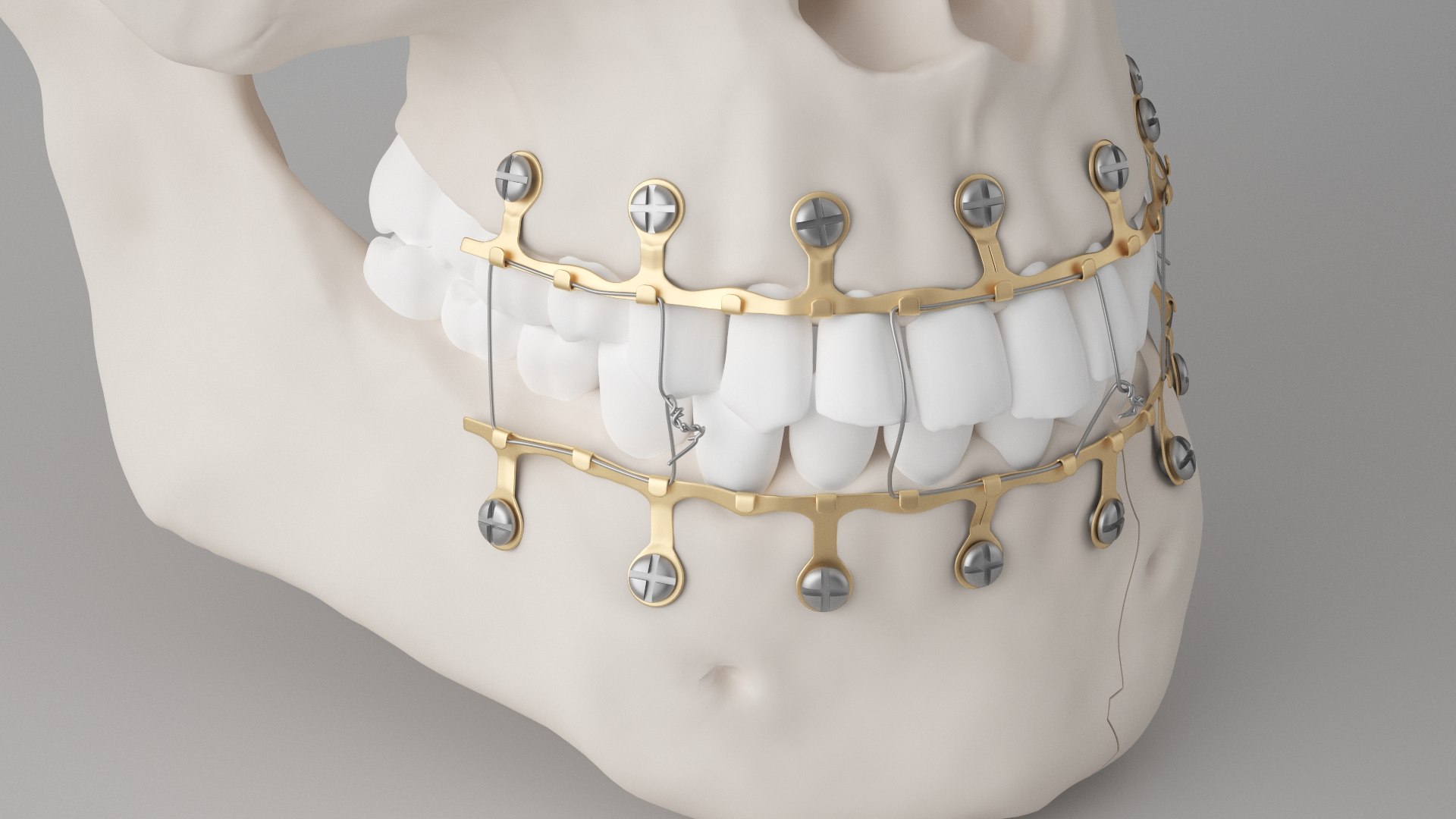 Male Skull - Mandible fracture 3D model https://p.turbosquid.com/ts-thumb/W6/IoJ3xH/4l/mandiblefracturepack05/jpg/1726988321/1920x1080/fit_q87/3acc8466fa74c445b13dc8e82f89b4bba80dbe9d/mandiblefracturepack05.jpg