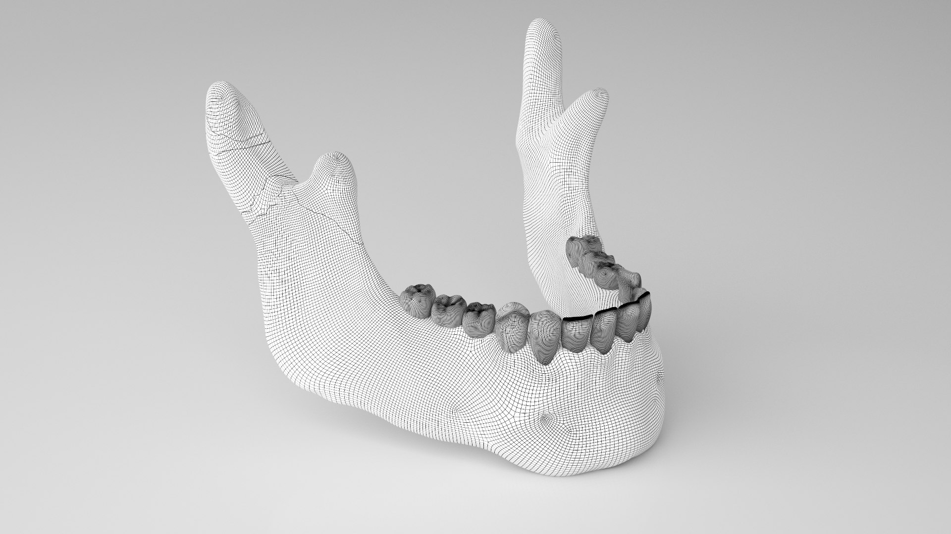 Male Skull - Mandible fracture 3D model https://p.turbosquid.com/ts-thumb/W6/IoJ3xH/50/mandiblefracturepack17/jpg/1726988326/1920x1080/fit_q87/a38849da73a962021504fcf4a8342ff5a64ff311/mandiblefracturepack17.jpg