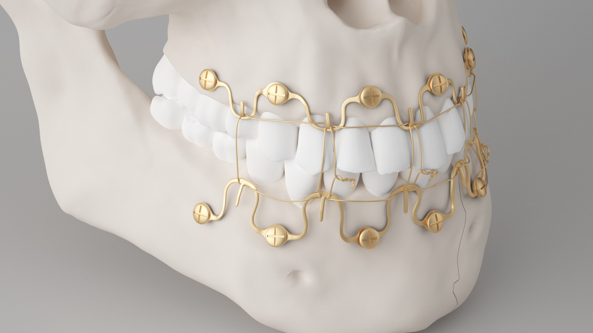 Male Skull - Mandible fracture 3D model https://p.turbosquid.com/ts-thumb/W6/IoJ3xH/7B/mandiblefracturepack02/jpg/1726988321/1920x1080/fit_q87/9668782805f00c52d03592ec94977c7c9640b96f/mandiblefracturepack02.jpg
