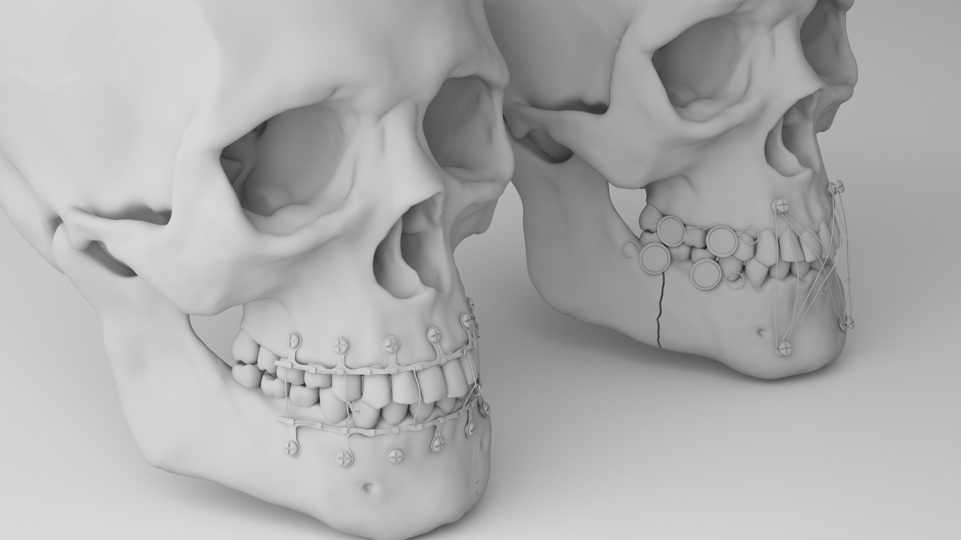 Male Skull - Mandible fracture 3D model https://p.turbosquid.com/ts-thumb/W6/IoJ3xH/AZ/mandiblefracturepack14/jpg/1726988325/1920x1080/fit_q87/bb6b426a2770a8efbfef6b92aaa4cfc02e81f44b/mandiblefracturepack14.jpg