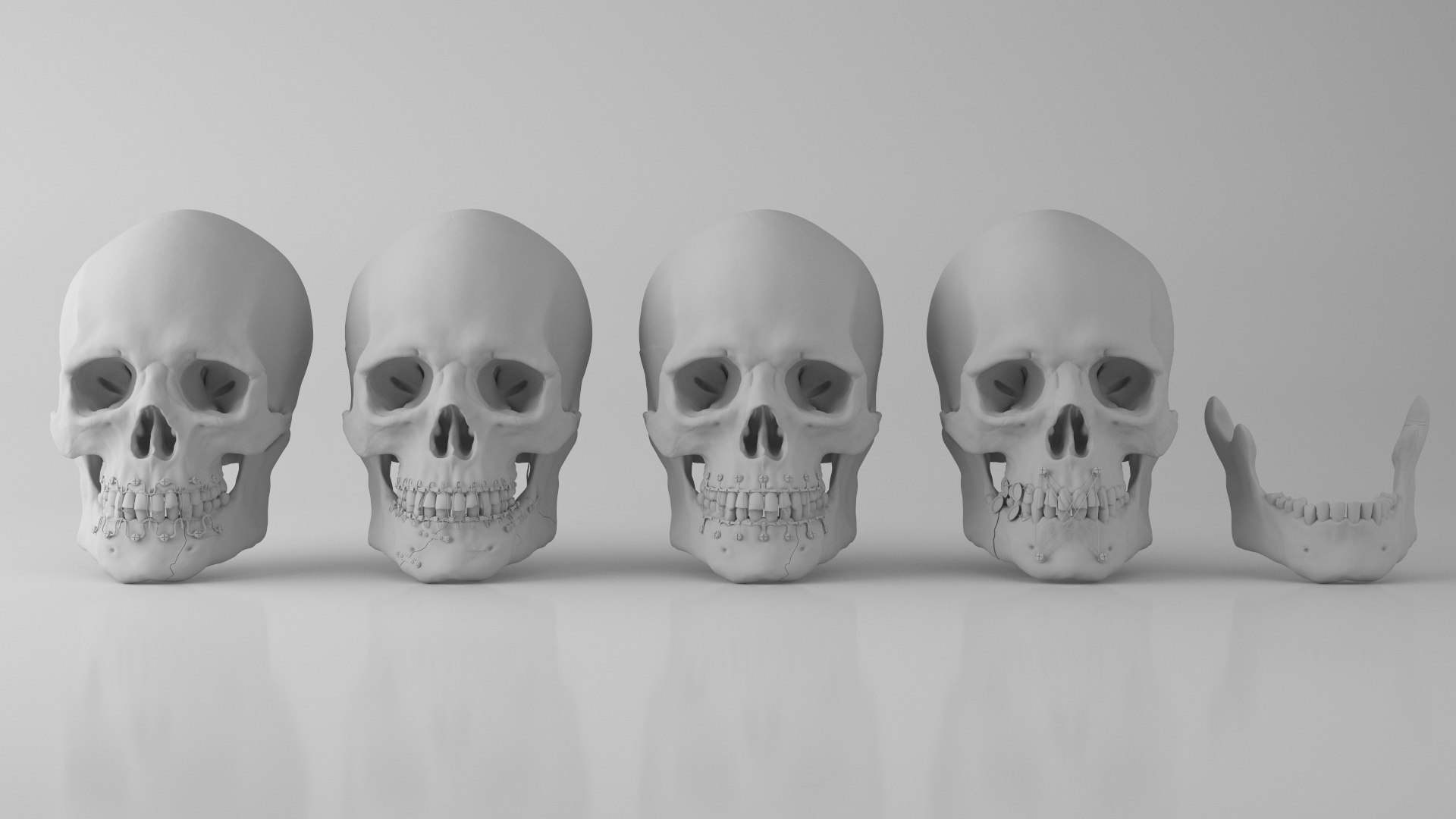 Male Skull - Mandible fracture 3D model https://p.turbosquid.com/ts-thumb/W6/IoJ3xH/Dc/mandiblefracturepack10/jpg/1726988359/1920x1080/fit_q87/79356a503e139b13ade2a7d4e4d03a09eaf7342e/mandiblefracturepack10.jpg