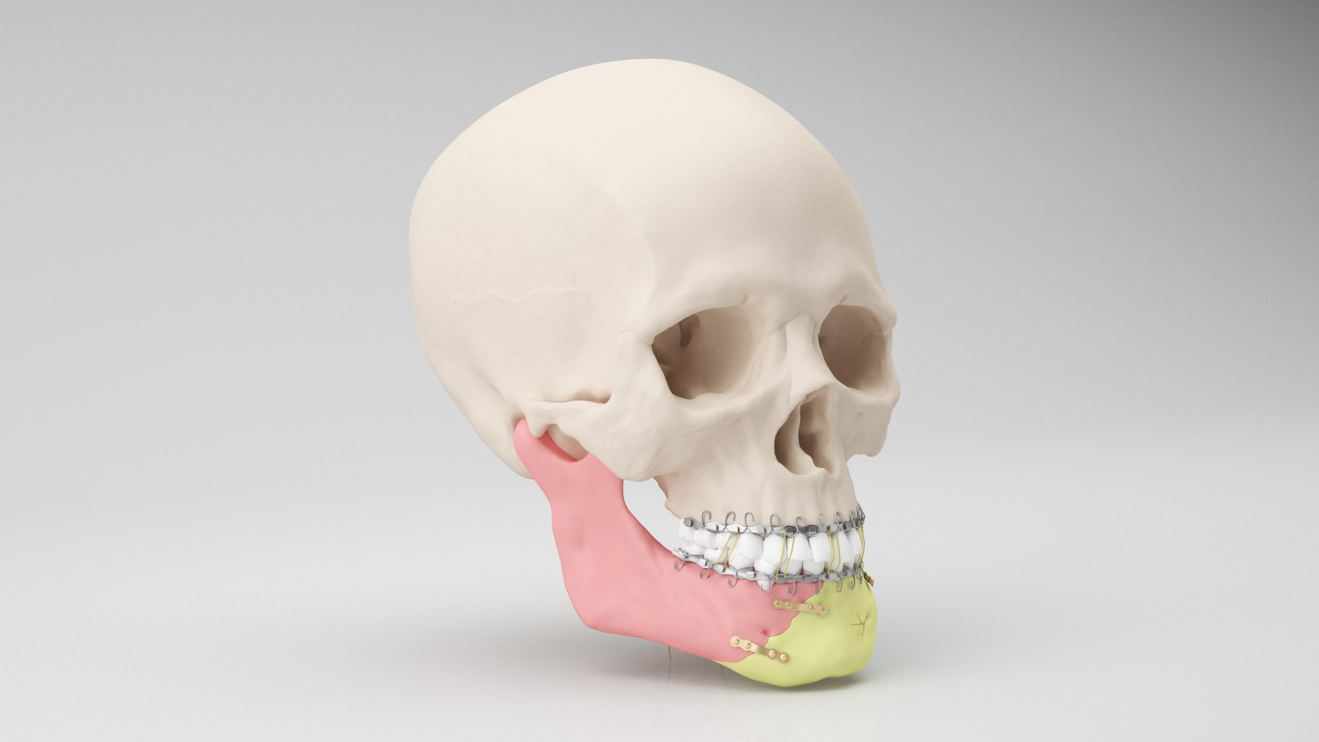 Male Skull - Mandible fracture 3D model https://p.turbosquid.com/ts-thumb/W6/IoJ3xH/EA/mandiblefracture02/jpg/1726988316/1920x1080/fit_q87/b9e4bb6fc3005ce003e4b6fd1f87b14ffcbf6bb1/mandiblefracture02.jpg