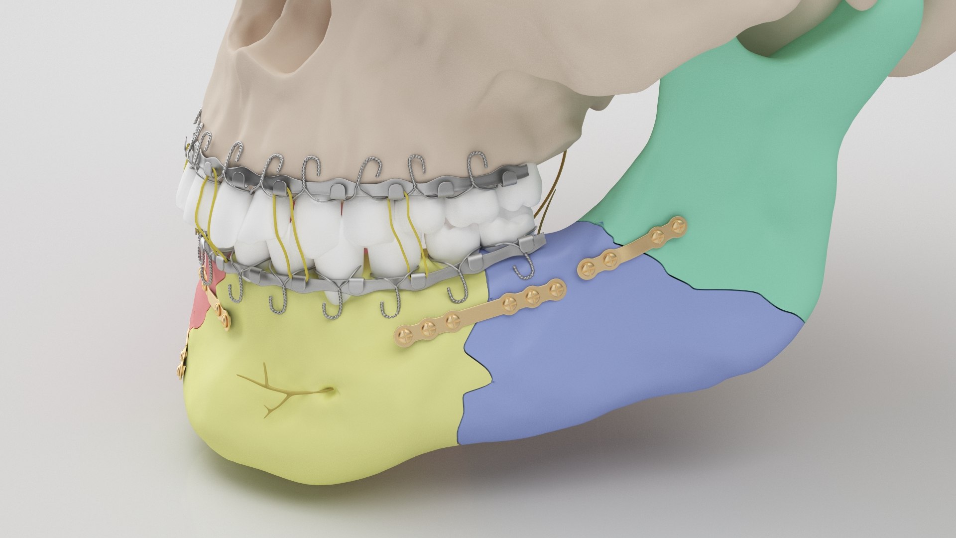 Male Skull - Mandible fracture 3D model https://p.turbosquid.com/ts-thumb/W6/IoJ3xH/Fa/mandiblefracture05/jpg/1726988318/1920x1080/fit_q87/195a0e44848576b6e00e52431c92d99061dcb18f/mandiblefracture05.jpg