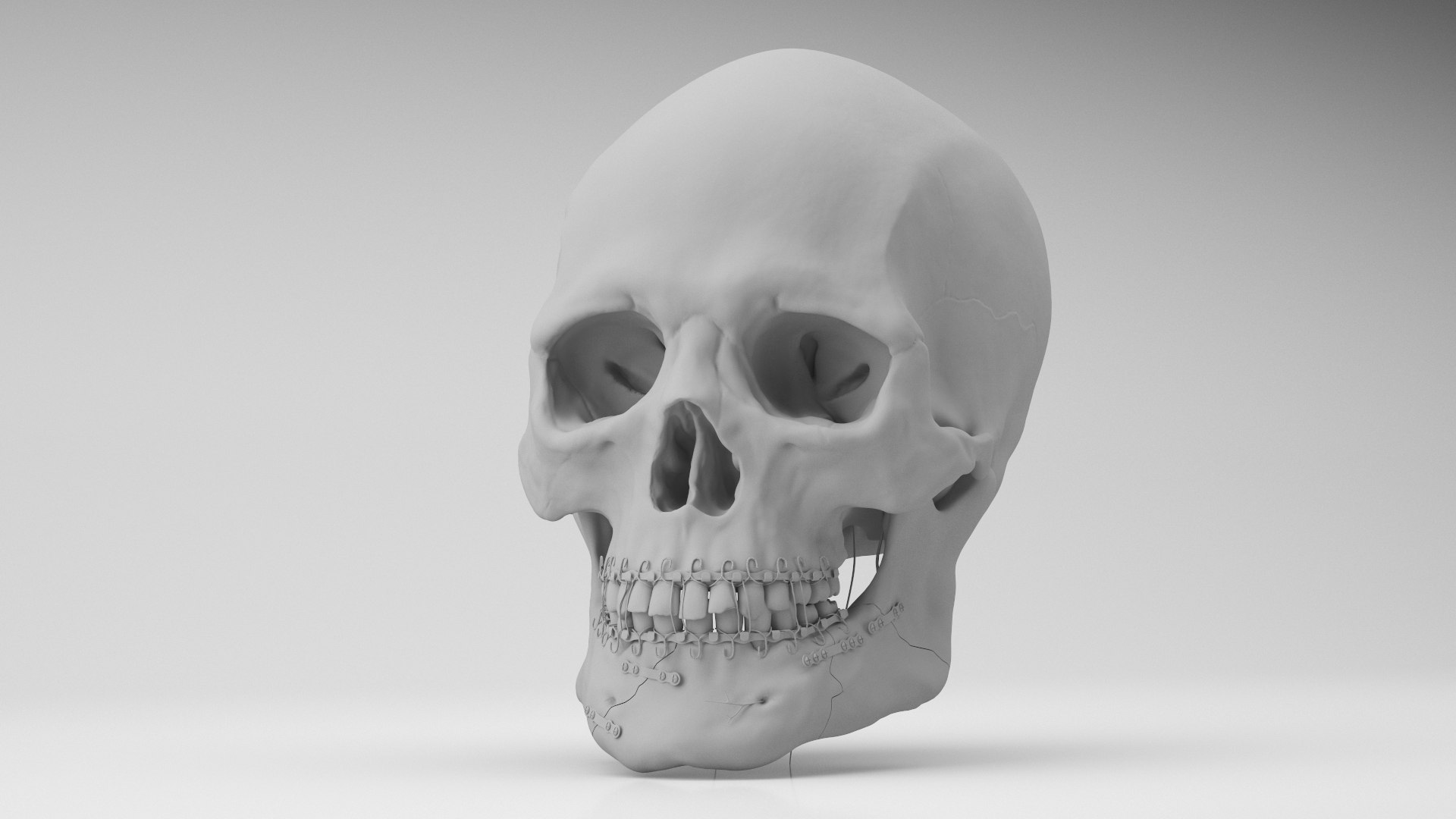 Male Skull - Mandible fracture 3D model https://p.turbosquid.com/ts-thumb/W6/IoJ3xH/Hk/mandiblefracture07/jpg/1726988319/1920x1080/fit_q87/3bbb0c77a17034cddf09b330fb448532f66a9b10/mandiblefracture07.jpg