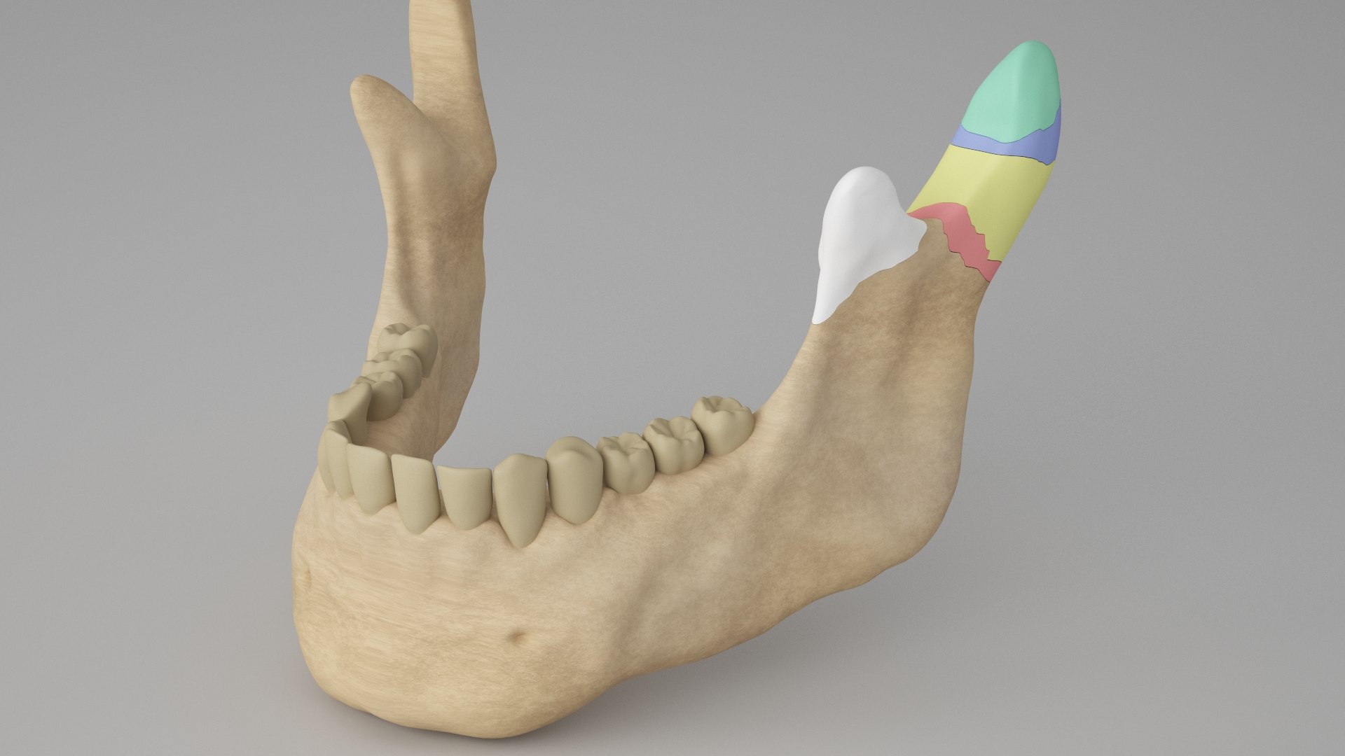Male Skull - Mandible fracture 3D model https://p.turbosquid.com/ts-thumb/W6/IoJ3xH/TS/mandiblefracturepack07/jpg/1726988322/1920x1080/fit_q87/b399c6ded785f46b169f081180c237ec5eaf290c/mandiblefracturepack07.jpg