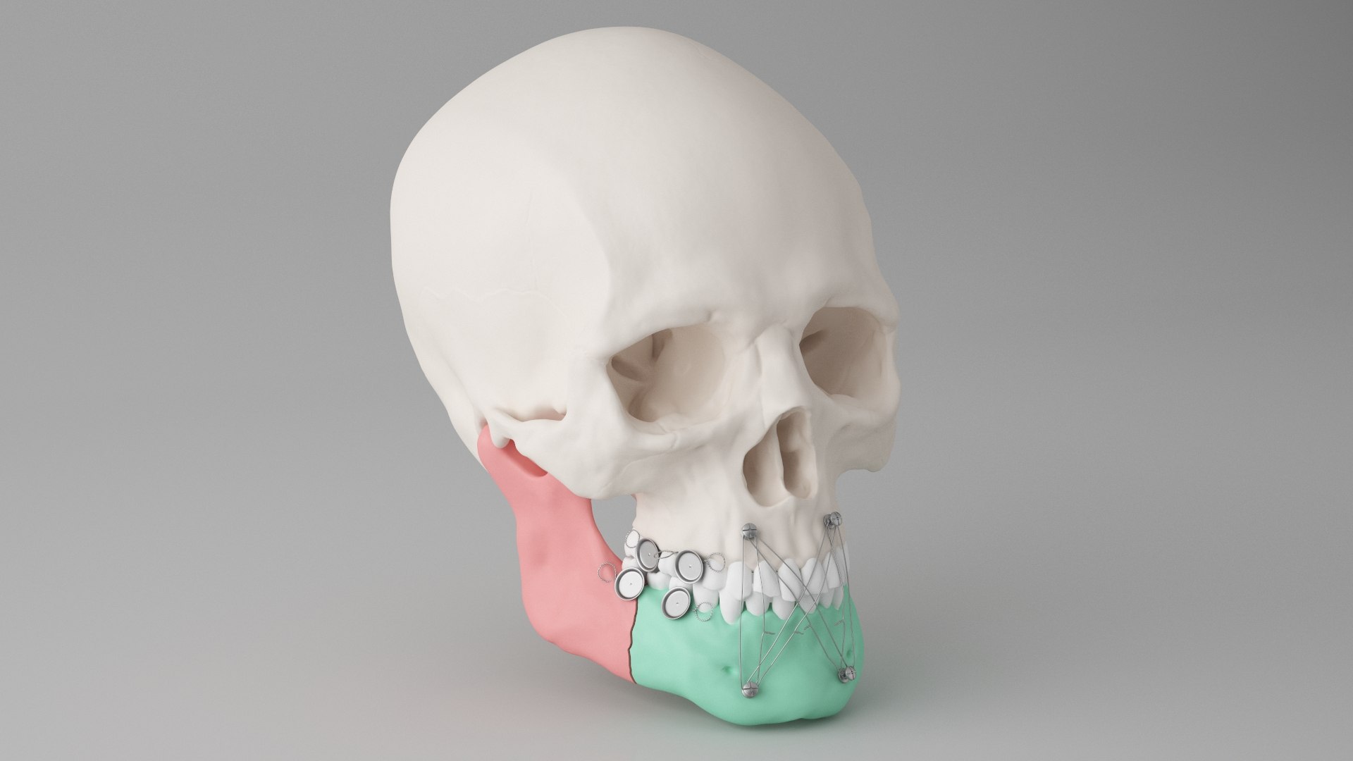 Male Skull - Mandible fracture 3D model https://p.turbosquid.com/ts-thumb/W6/IoJ3xH/VH/mandiblefracturepack08/jpg/1726988323/1920x1080/fit_q87/a2dc7eb5bf752448c5ed62ba3e5a2816527a372c/mandiblefracturepack08.jpg